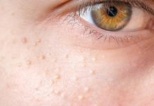 Yüzünüzdeki Küçük Beyaz Noktalarla Nasıl Başa Çıkabilirsiniz?