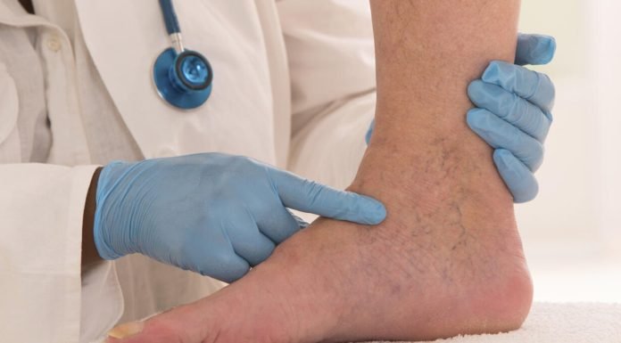 Hareketsizlik Hastalığı: Varisten Korunmanın Yolları