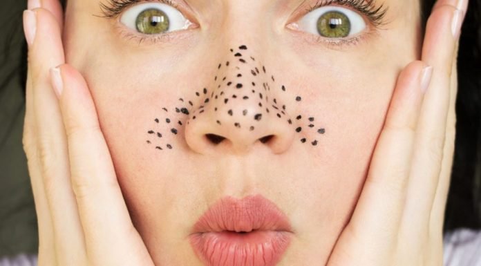 Burunda Oluşan Siyah Noktalar Nasıl Geçer?